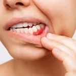 Moderate Gum Disease