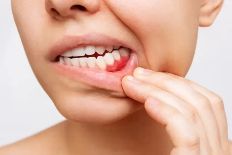 Moderate Gum Disease