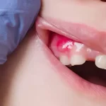 Tooth Infection