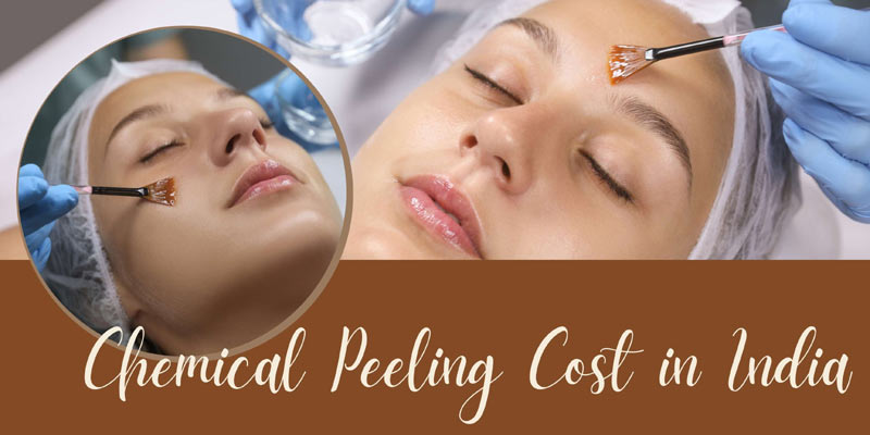 Chemical Peel