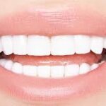 Full Set of Veneers